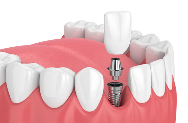 FATHIMA DENTAL CLINIC KIZHISSERI